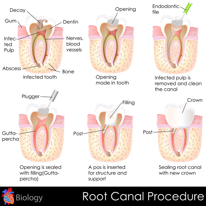 Root Canal